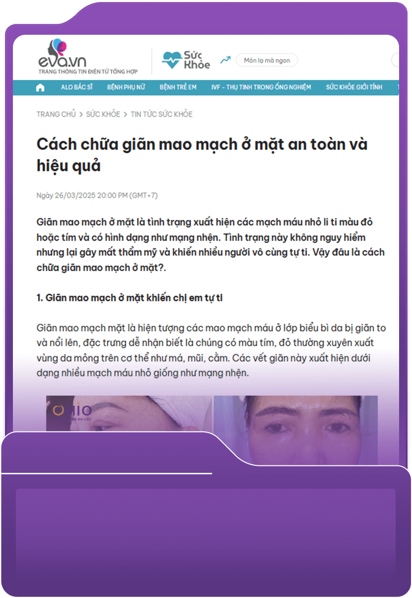 Cách chữa giãn mao mạch ở mặt an toàn và hiệu quả